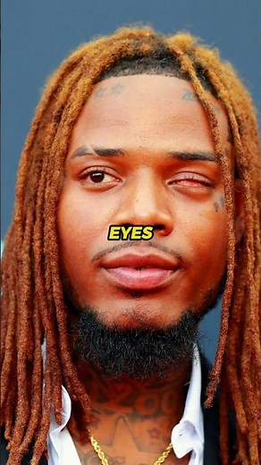 Almost Lost Both His Eyes… Fetty Wap Story😳