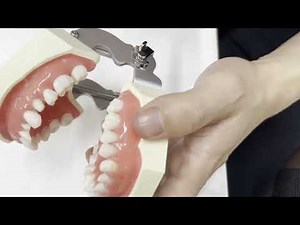 お口が開かない、舌圧が強い患者さんの場合の形成時対応方法：前編