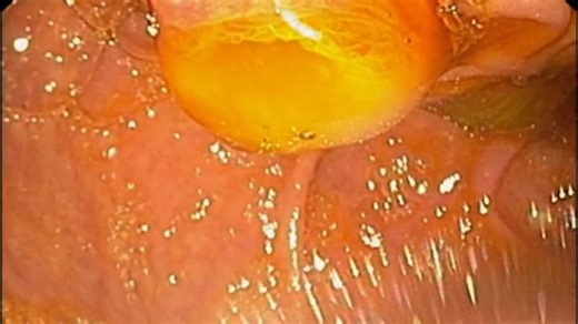 02 CoM February 26 - Fish-mouth papilla (main duct IPMN) | Gastro Cloud