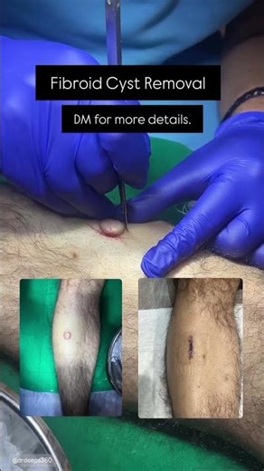 Fibroid cyst on leg..Watch this Satisfying Cyst REMOVAL! #satisfyingvideo #shorts #bestdermatologist