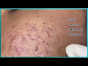 Big Cystic Acne Blackheads Extraction Blackheads & Milia, Whiteheads Removal Pimple Popping