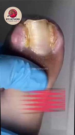 Natural Nail Solutions for Cracked Toenails For Better Hygiene #SimpleNailCare #HealthyNails #NailCareTips #CleanNailsDaily | Bye