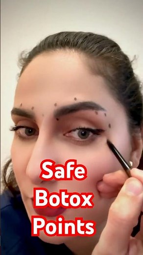 Botox Injection Points on the Face | Safe & Natural Results #montrealbeauty