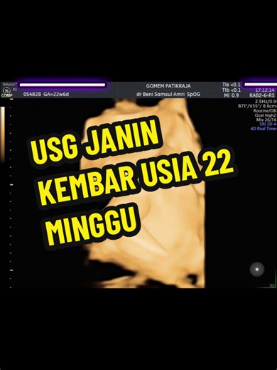 USG Kehamilan 22 Minggu Kembar di Purwokerto