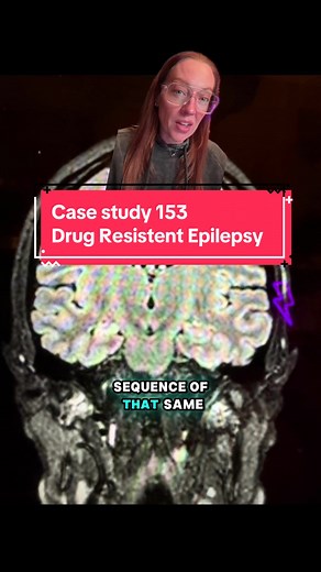 Understanding Drug Resistant Epilepsy: A Case Study