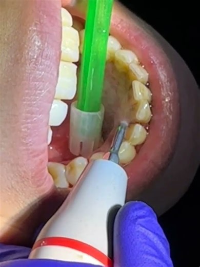 Satisfying tartar(calculus) removal #satisfying #calculus