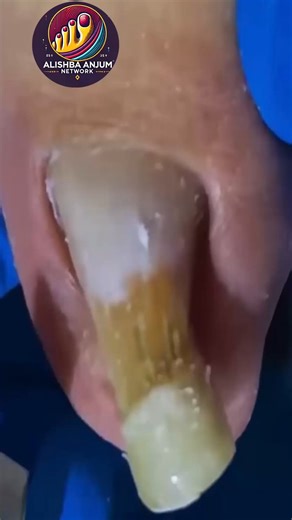 Natural Nail Solutions for Cracked Toenails Using Safe At-Home Techniques 🌹🪷 #FootSupport #HealthyHabits #FootWellnessUSA | Alishba Anjum vlog