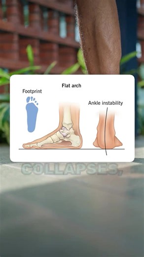 Introducing Frido Arch Support Insoles Designed to provide arch correction for those with flat feet. Helps in relieving pain from overpronation & knock knees overtime. ✅ Supports proper foot Alignment ✅ Suitable for standing & walking ✅ Relief from arch pain ✅ Designed for Indian feet | Frido