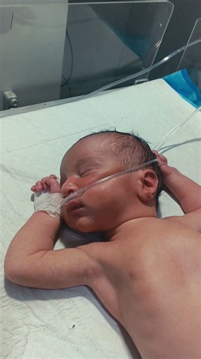 RDS Newborn Baby 😢 | Respiratory Distress Syndrome in NICU | Oxygen & CPAP Support