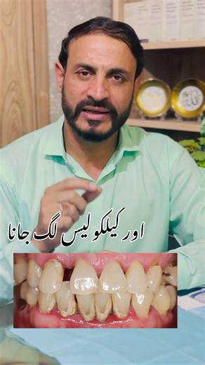 “Yellow Teeth & Calculus? Quick Treatment Explained!”