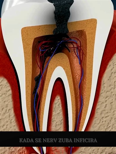 🦷 Šta se zapravo dešava tokom lečenja kanala zuba? (Kako stomatolog uklanja infekciju iz nerva) #zub #zubar #stomatolog #stomatologija #kanalzuba #lecenjekanala #zubninerve #nervzuba #zub #zubi #popravkazuba #zdravizubi #zdravljezuba #zubnabol #zubnainfekcija #infekcijazuba #zubnikanal #endodoncija #rootcanal #rootcanaltreatment #zubnizdravlje #medicina #zdravlje #medicinskicinjenice #naucnoobjasnjenje #kakofunkcionise #kakofunkcionisezub #kakofunkcionisetelo #kakofunkcionisezub #kakolecenjekan
