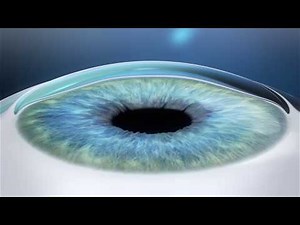 LASIK - Hong Kong Laser Eye Centre