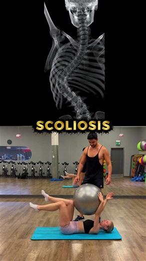 What X-Rays don't show you about Scoliosis progression | SpineX