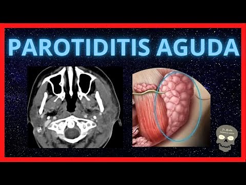 ACUTE PAROTIDITIS 👉RADIOLOGICAL FINDINGS