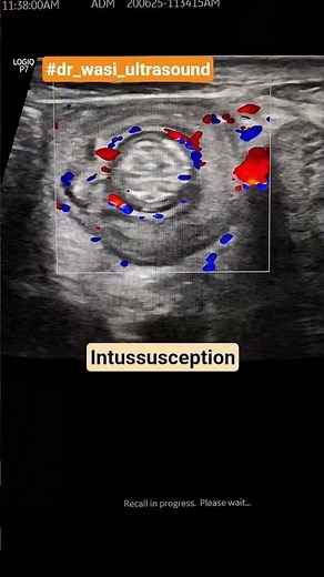 intussusception #dr_wasi_ultrasound #medicalimaging #ultrasonography