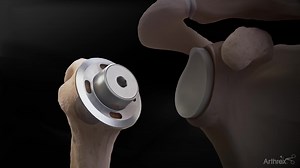 Eclipse™ Total Shoulder Arthroplasty System