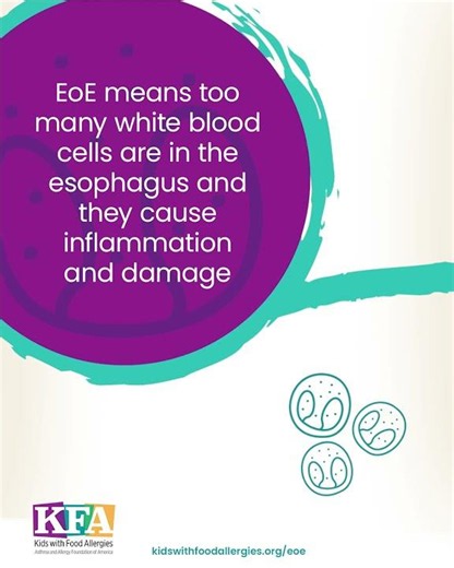 Eosinophilic esophagitis (#EoE) Is a Chronic Inflammatory Condition