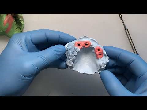 Verification Jig Fabrication, Pouring a Multi implant Impression, Custom Tray