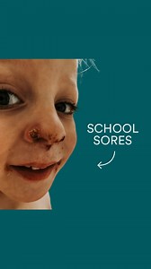 This was my boy just last week 😭 I thought it was cold sores at first but it turned out to be Impetigo aka School Sores. This isn’t talked about as much so I thought I’d share some info with you all and how we are managing it at home. Signs and Symptoms ➡️ Sores mainly on the face near the mouth and nose, or arms and legs. (but they can be anywhere on the body) ➡️ Starts as a blister ➡️ Blister bursts leaving behind red, weepy skin ➡️ Yellow crust on blister ➡️ Peeling around edge of sore ➡️ It