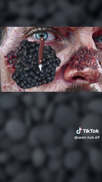 Maggot Removal ASMR Experience