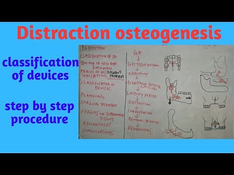 Distraction Osteogenesis part-II