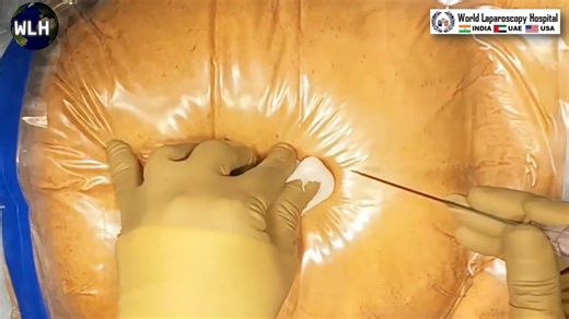 Innovative Laparoscopic Hysterectomy: Integrating ICG & U-Kit and Safe Contained Morcellation