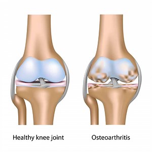 Total Knee Replacement | Sunshine Coast Orthopaedic Group