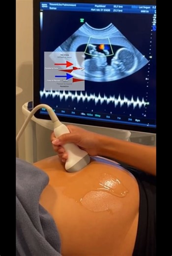 🧐 WATCH closely: Triple heartbeats in 4K! ❤️#triplets #ultrasound #pregnant #ultrasou