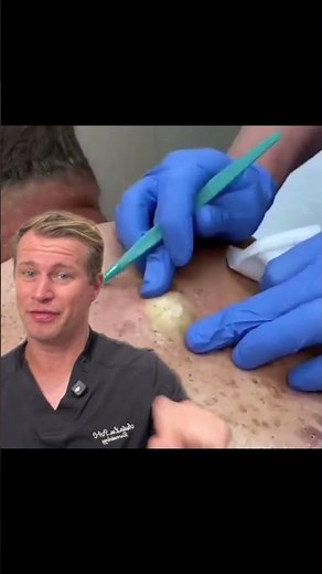 Volcanic cyst eruption!! #eruption #pimple #foryou #pimple #pimplepopping #fyp #huge #dermatology