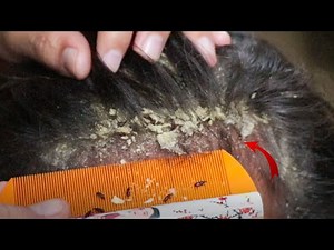 Removed Hundred of Lice From Head and Dry Scalp Huge Dandruff of Flakes Removal With Comb # 1765