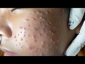 Make your Acne Treatment Huong Da Nang | 461# acne 2022
