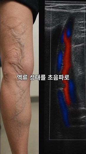 양산에서 하지정맥류 때문에 병원 찾고 계신가요 #하지웰흉부외과