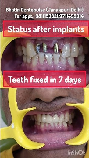 life changing video with magical smile transformation with Basal -Compressive implants in 7 days