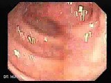 Adenocarcinoma of the Transverse Colon (2 of 5) • Video • MEDtube.net