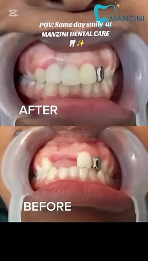 Get your same day tooth replacement with us 💃🤌🏼 Schedule your appointment with us today: 031 023 1847 074 085 4761 #dentalbridge #kzn #dentistry #SAMA28