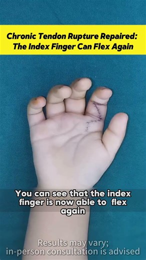 Chronic Tendon Rupture Repaired: The Index Finger Can Flex Again.#doctor #hand #before and after