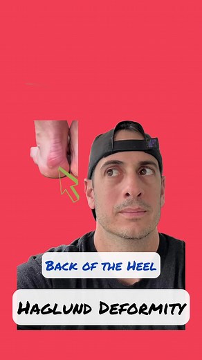 Back of the Heel: Haglund Deformity Prolonged irritation to the back of the heel can trigger the body’s defensive response, leading to the formation of additional bone atop the existing one. This resultant bony enlargement at the back of the heel is termed Haglund deformity. Certain types of shoes and repetitive stresses to the heel can be the culprit to this deformity. What To Do Shoes- Experiment with different types of shoes and possible orthotic inserts. Xray and/or MRI : Imaging for accurat