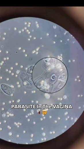 Marilyn | CLS MLS(ASCP) on Instagram: "This is what a vaginal parasite actually looks like under the microscope. Yes… it really moves like that. What you’re seeing here is Trichomonas vaginalis, a sexually transmitted parasite. It’s transmitted through sexual contact and commonly causes vaginal discharge, itching, irritation, and discomfort, though many people can be asymptomatic. In this video, you can see its characteristic jerky, tumbling motility, and it’s literally dragging a red blood cell
