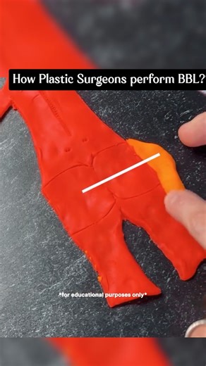 Dr Prashant Yadav on Instagram: "How Plastic Surgeons Perform BBL? #BBLSurgery #BrazilianButtLift #DrPrashantYadav #Dezireclinic #CosmeticSurgery #BodyContouring #FatTransfer #AestheticTreatment #SurgeryEducation #PlasticSurgeryFacts"