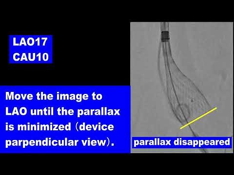 Cusp Overlap Technique with HEARTROID TAVI model
