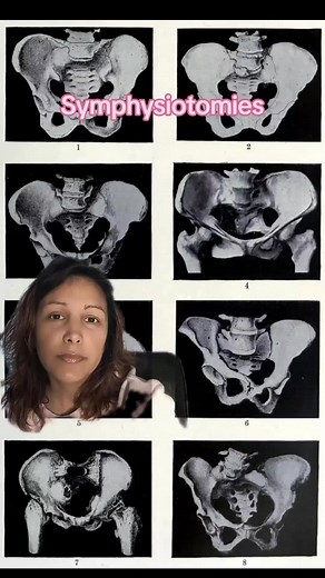 Chainsaws for childbirth? True. 😱🤯 #birth #childbirtheducation #childbirthherstory #factorfiction