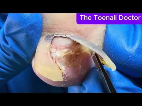 WARNING: Worst Ingrown Toenail Ever #viral #viralvideo #doctor