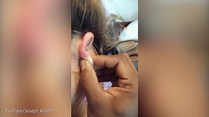 Stomach churner: Man squeezes puss out of girlfriend's cyst