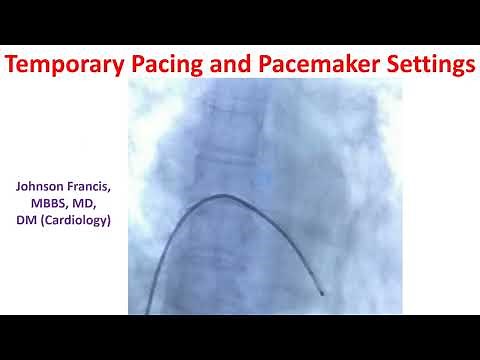 Temporary Pacing and Pacemaker Settings