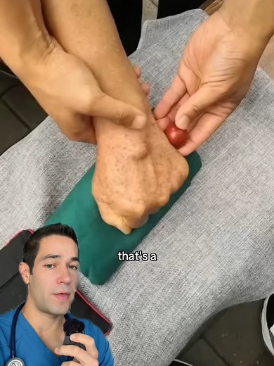 Ganglion Cyst Explained by a Doctor