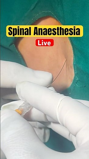 Real Spinal Injection: Watch How Anaesthesia Is Given Before Surgery! #shorts #spinalanesthesia