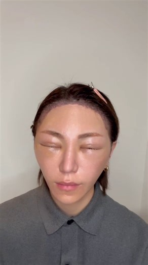 【リアル公開】切開リフト3ヶ月目。まだ赤い傷あるし、触るとボコボコしてて普通に痛い。これ本当に消える？無理そうならレーザー考えてる。同じ経験ある人、どうなったか教えて。