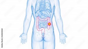 Animation of colon cancer in a man's ascending colon