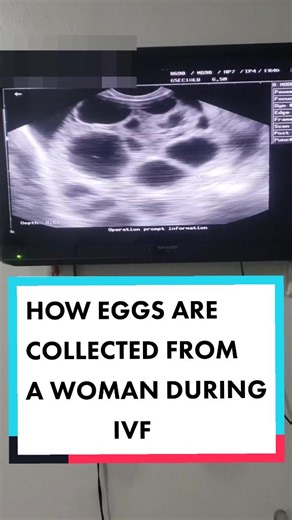 Understanding the Egg Collection Process in IVF