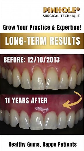 Proven Results: 11 Years of Pinhole® Success 🦷✨#gumrecession #cosmeticdentistry #gumrejuvenation